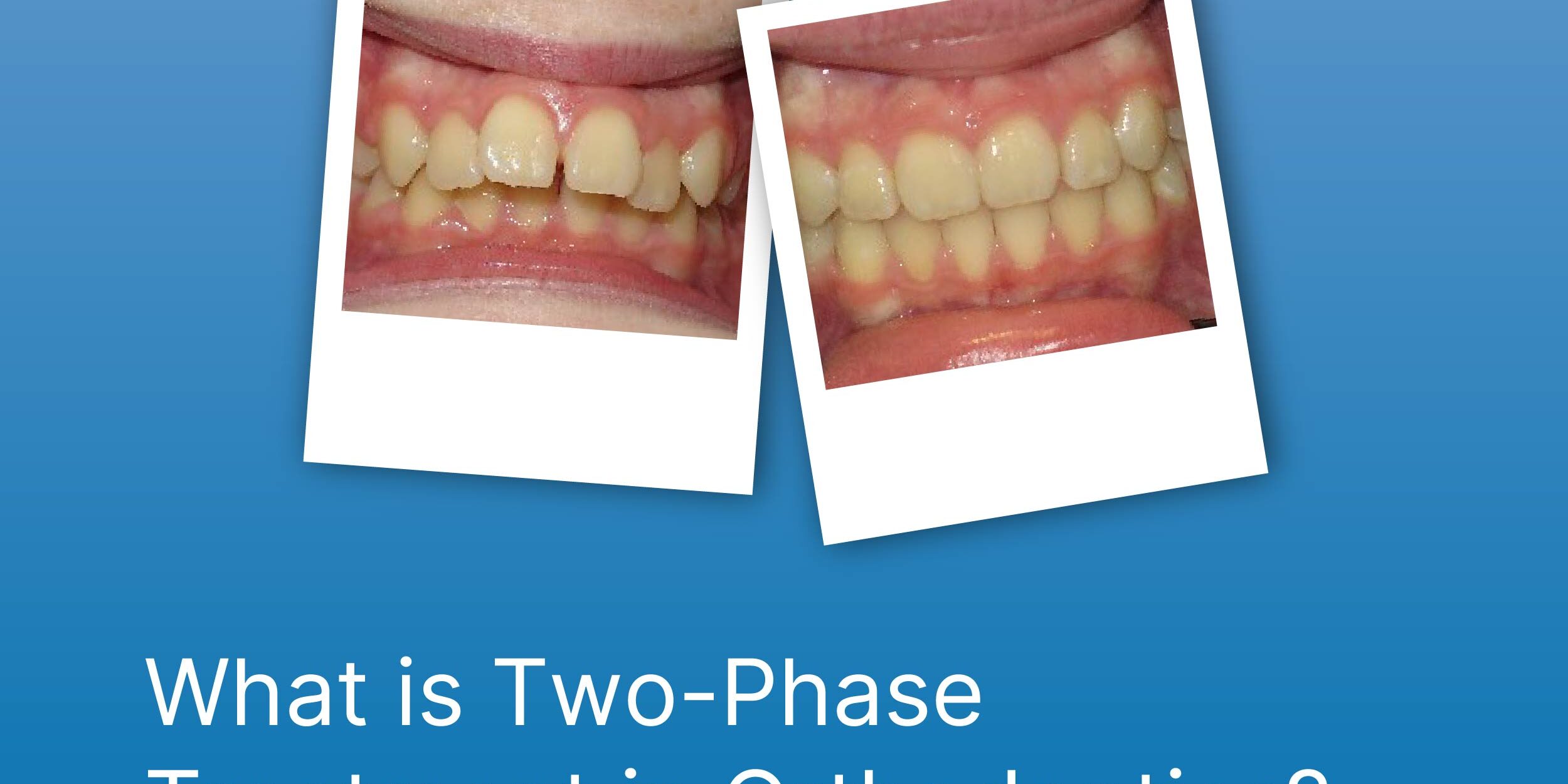 What is Two-Phase Treatment in Orthodontics?