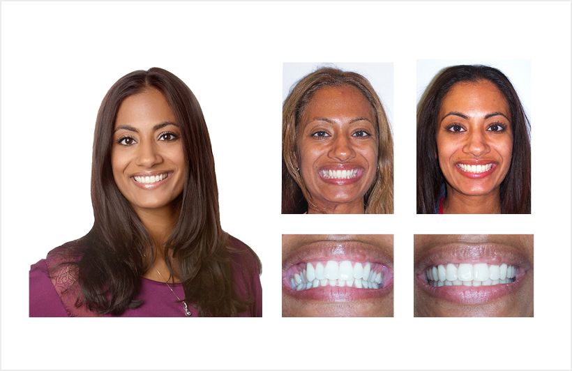 See before and after photos of our patients. Segal and Iyer Orthodontics.